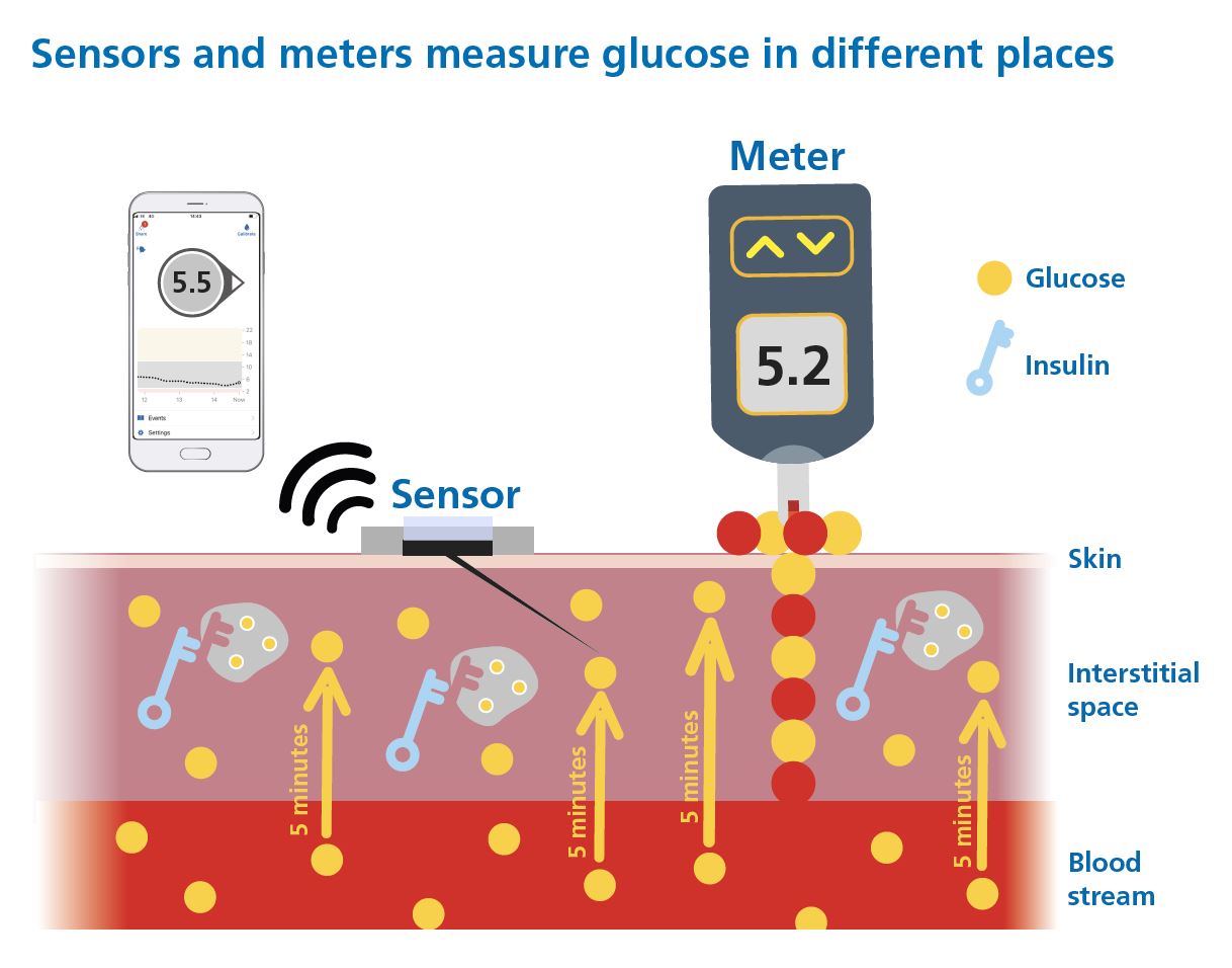 La mesure du glucose en continu (CGM)